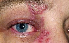 herpes en el ojo